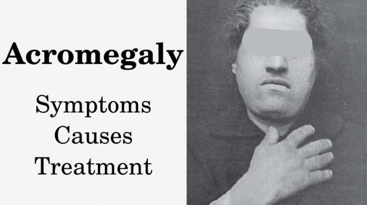 Acromegaly: symptoms, causes, treatment